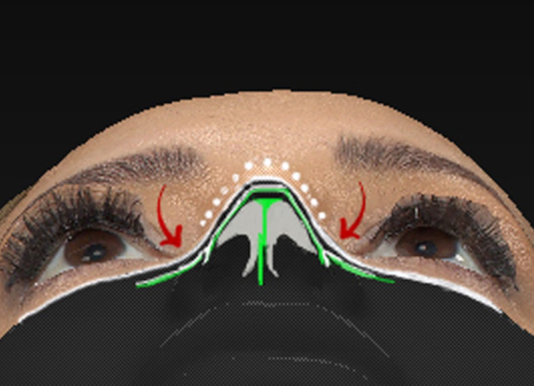 dorsal-preservation-rhinoplasty-1