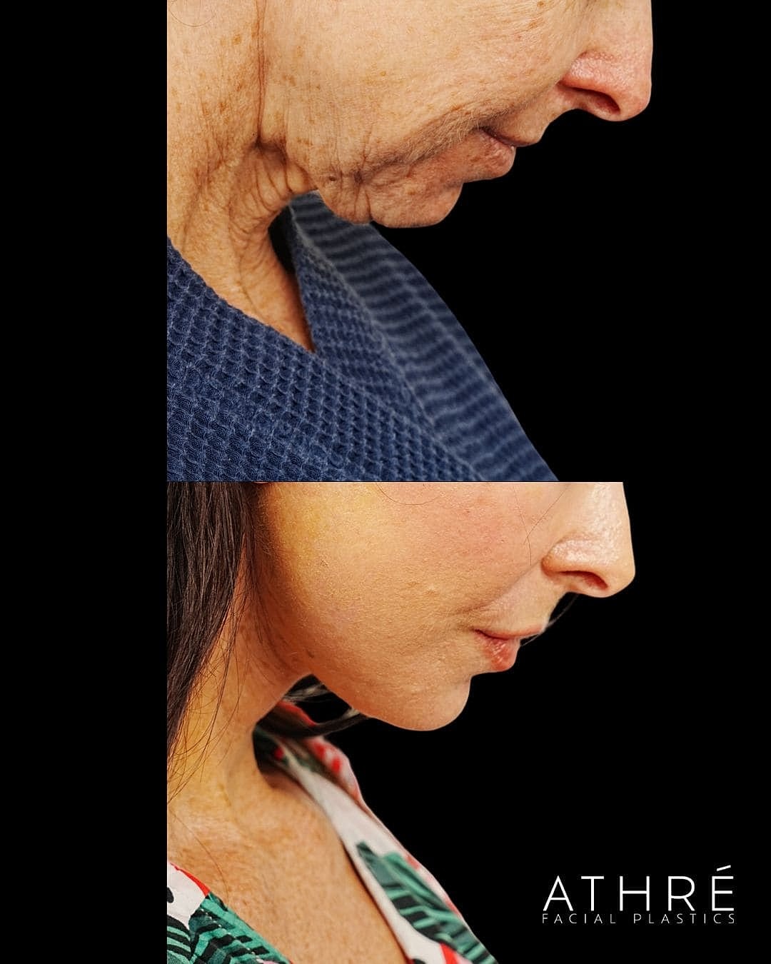 Before and after facial rejuvenation treatment comparison.