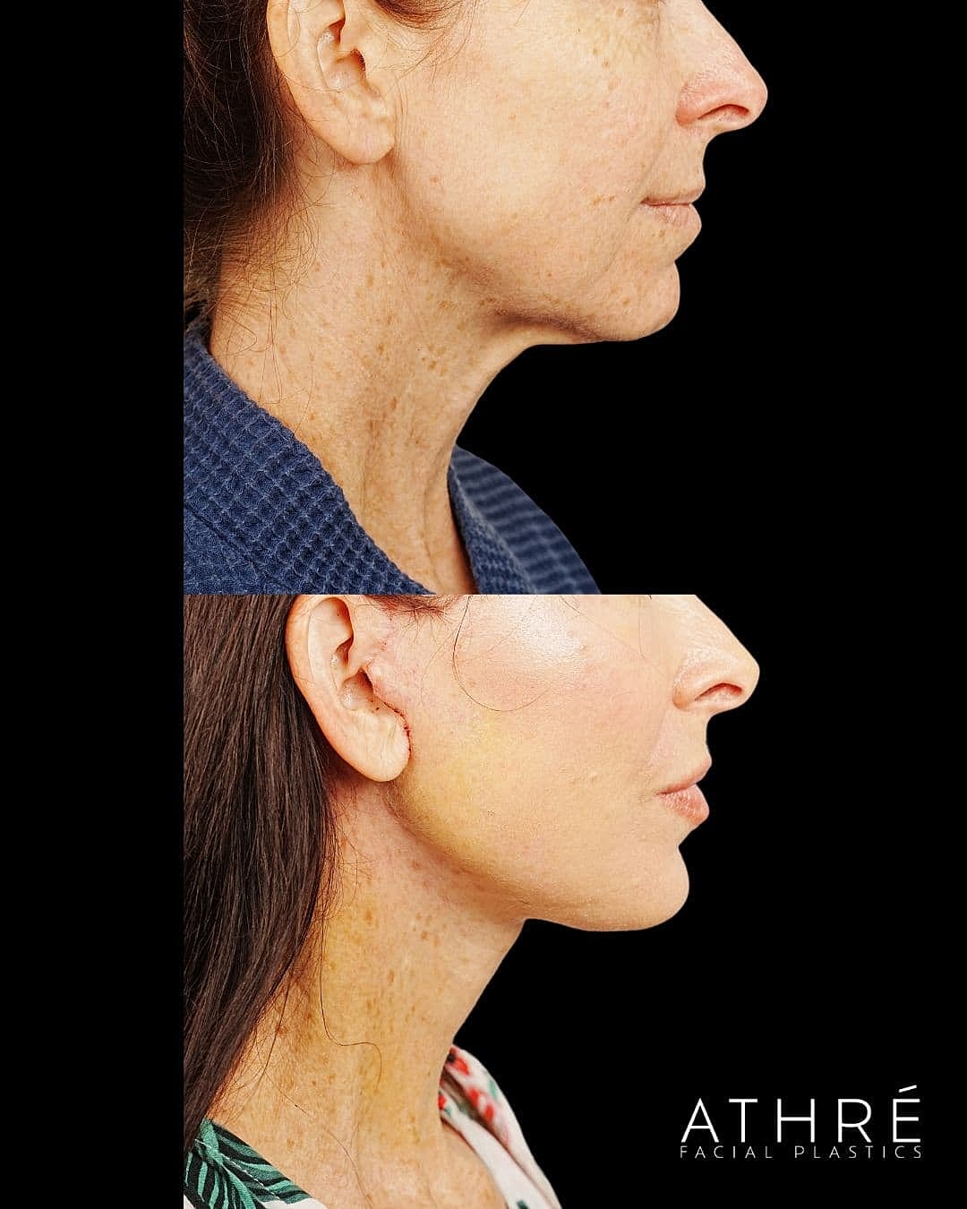 Before and after facial treatment comparison.