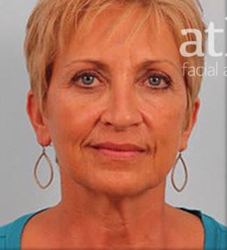 Neck Lift Before & After