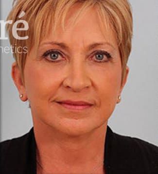 Neck Lift Before & After