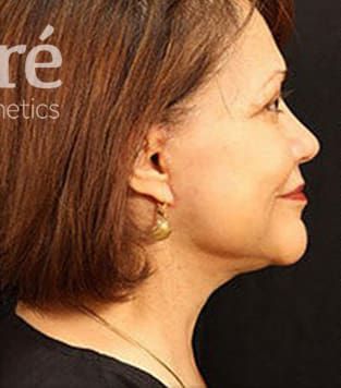 Neck Lift Before & After