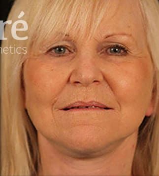 Neck Lift Before & After