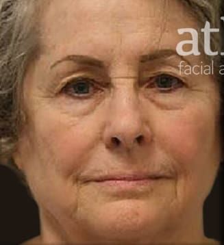 Neck Lift Before & After