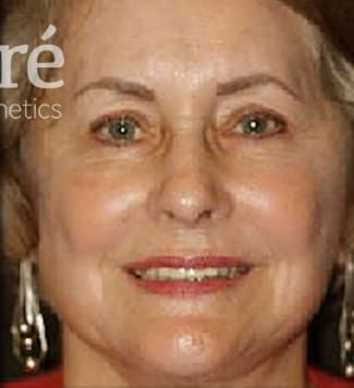 Neck Lift Before & After