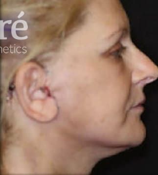 Neck Lift Before & After
