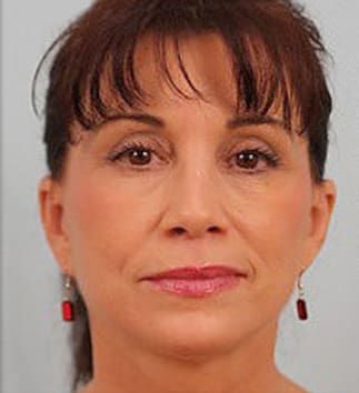 Neck Lift Before & After