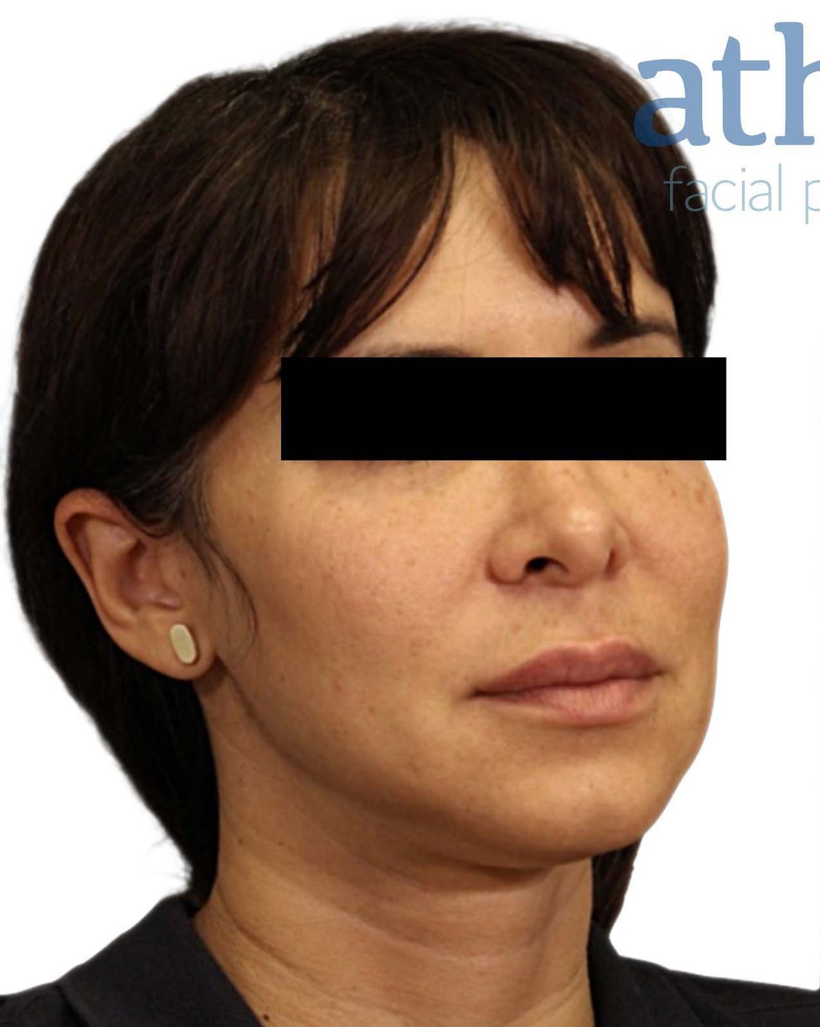 Neck Lift Before & After