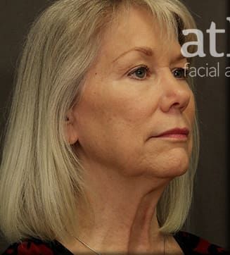 Neck Lift Before & After