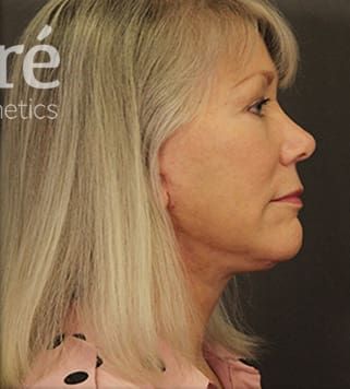 Neck Lift Before & After