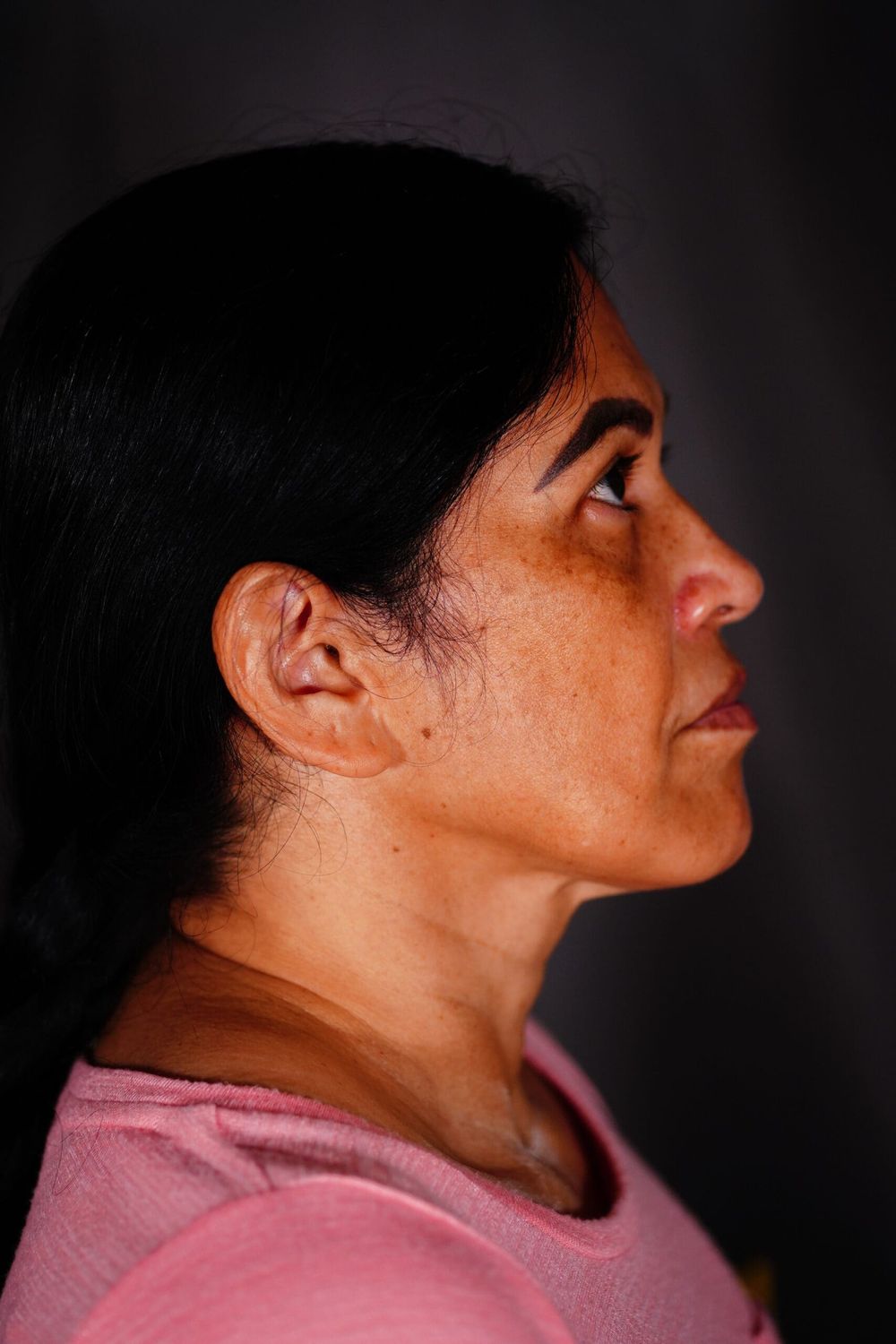 Neck Lift Before & After