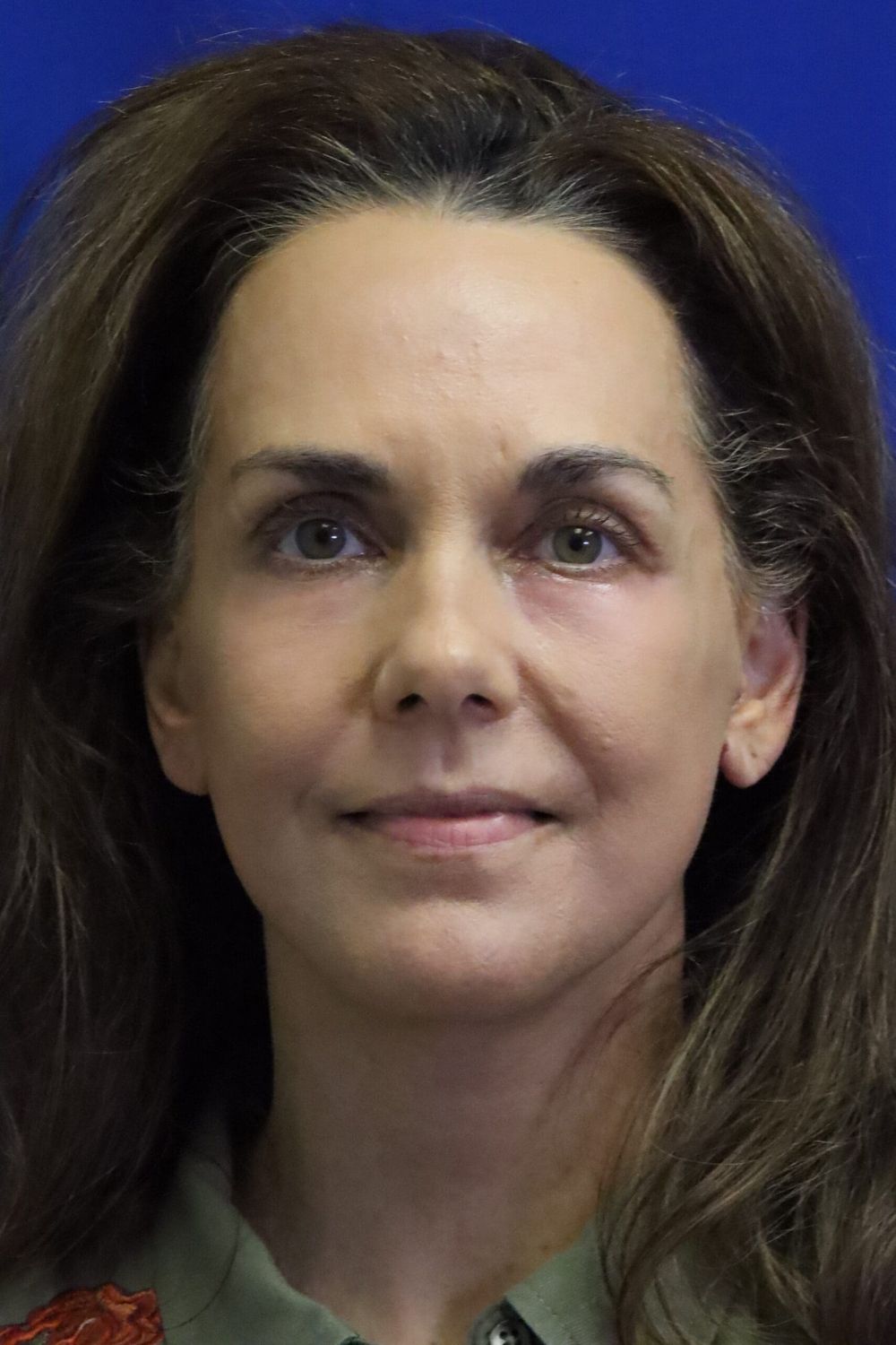 Neck Lift Before & After