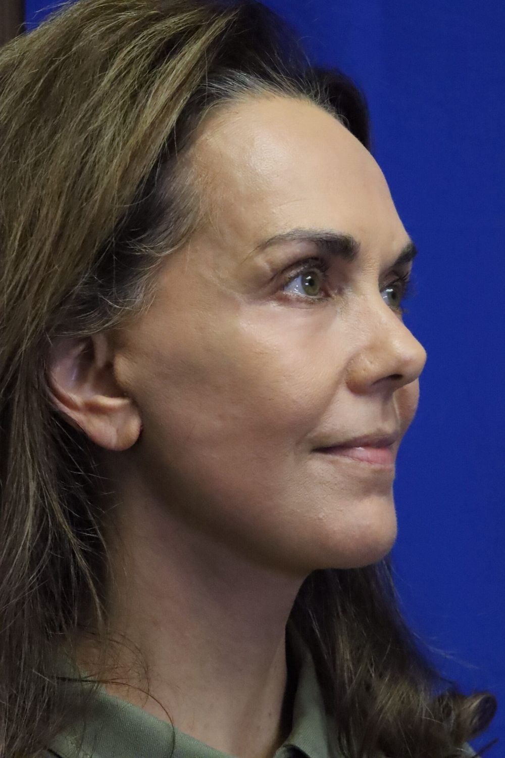 Neck Lift Before & After