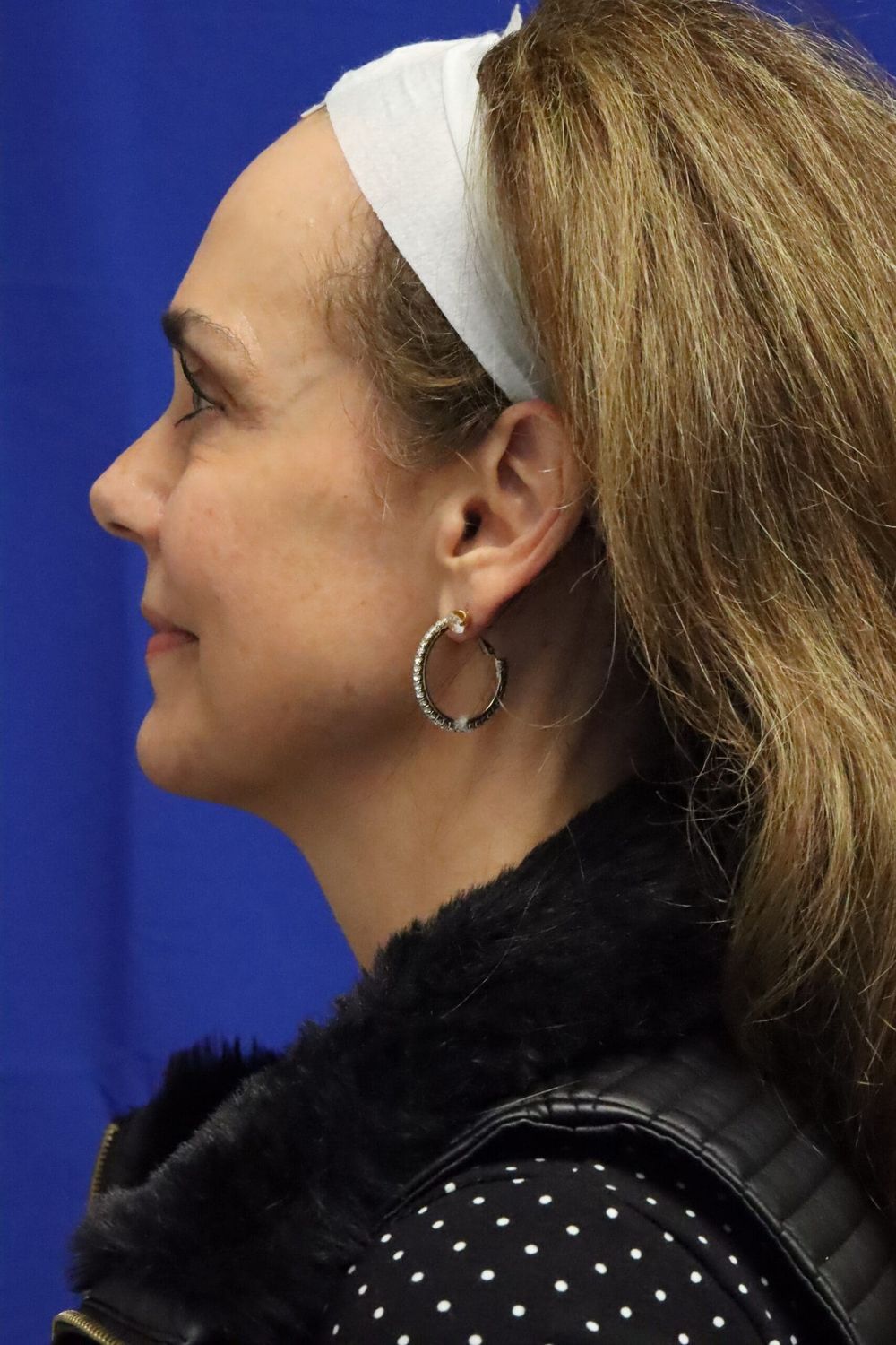 Neck Lift Before & After