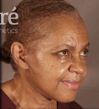 Neck Lift Before & After