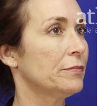 Neck Lift Before & After