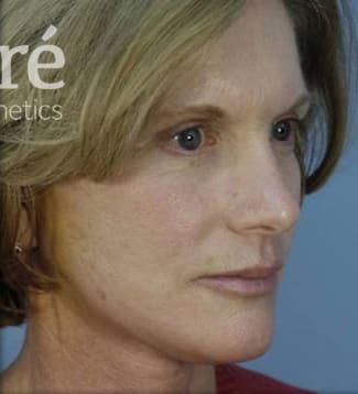 Neck Lift Before & After