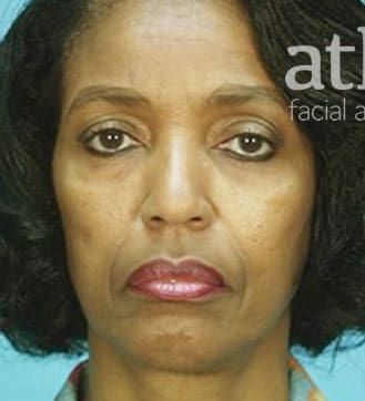 Neck Lift Before & After