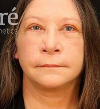 Neck Lift Before & After