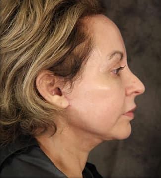Neck Lift Before & After