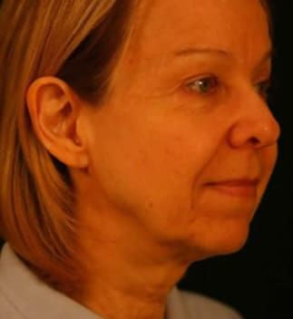 Neck Lift Before & After