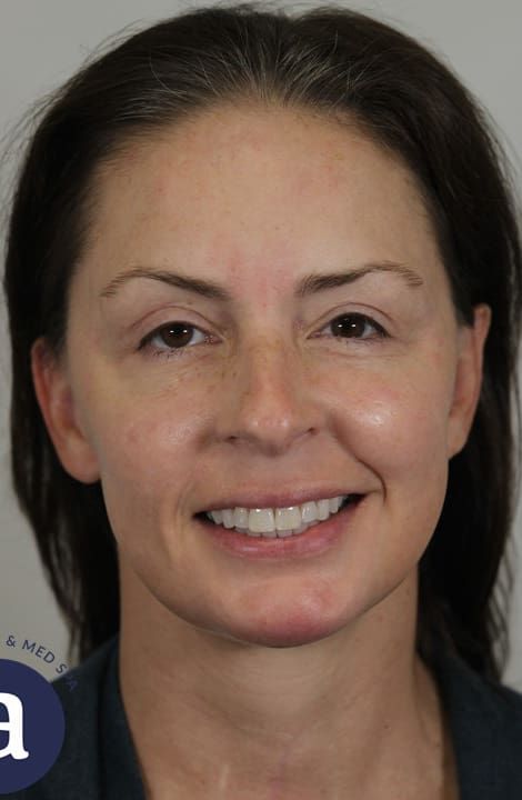 Neck Lift Before & After