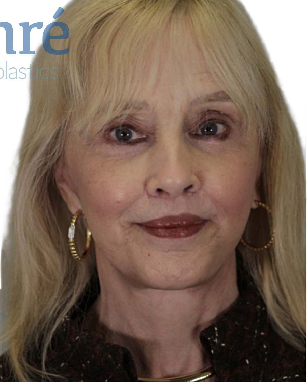 Neck Lift Before & After