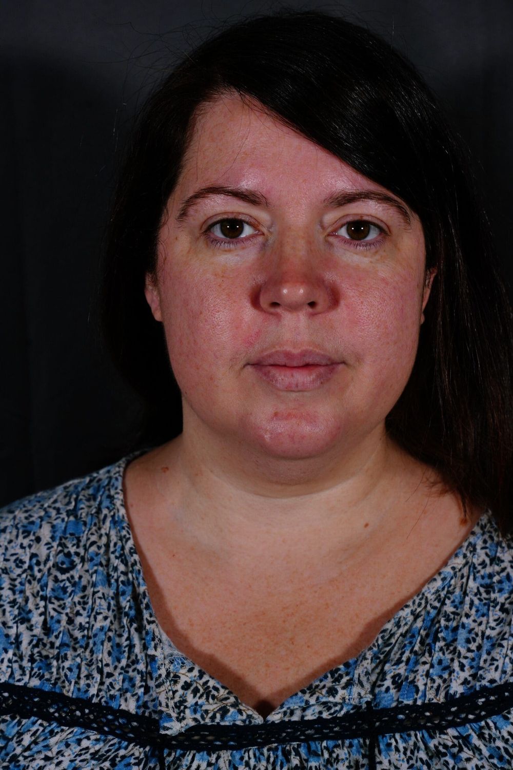 Neck Lift Before & After