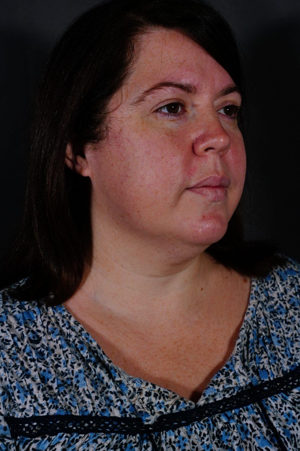 Neck Lift Before & After