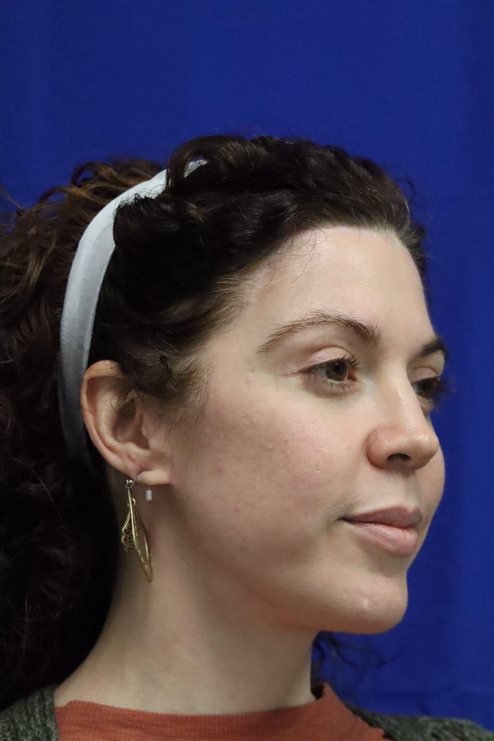 Neck Lift Before & After