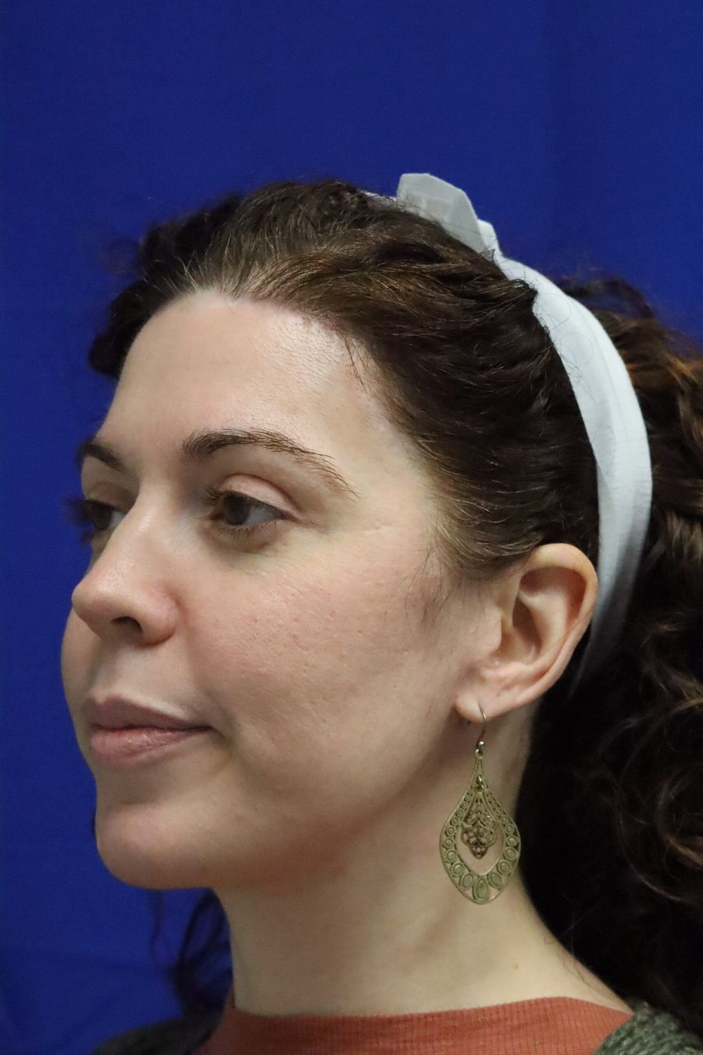 Neck Lift Before & After