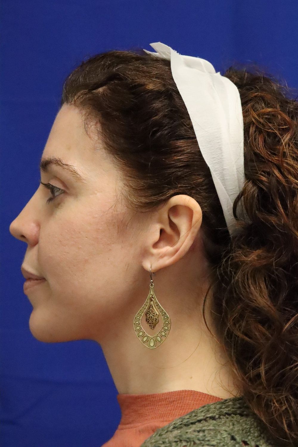 Neck Lift Before & After