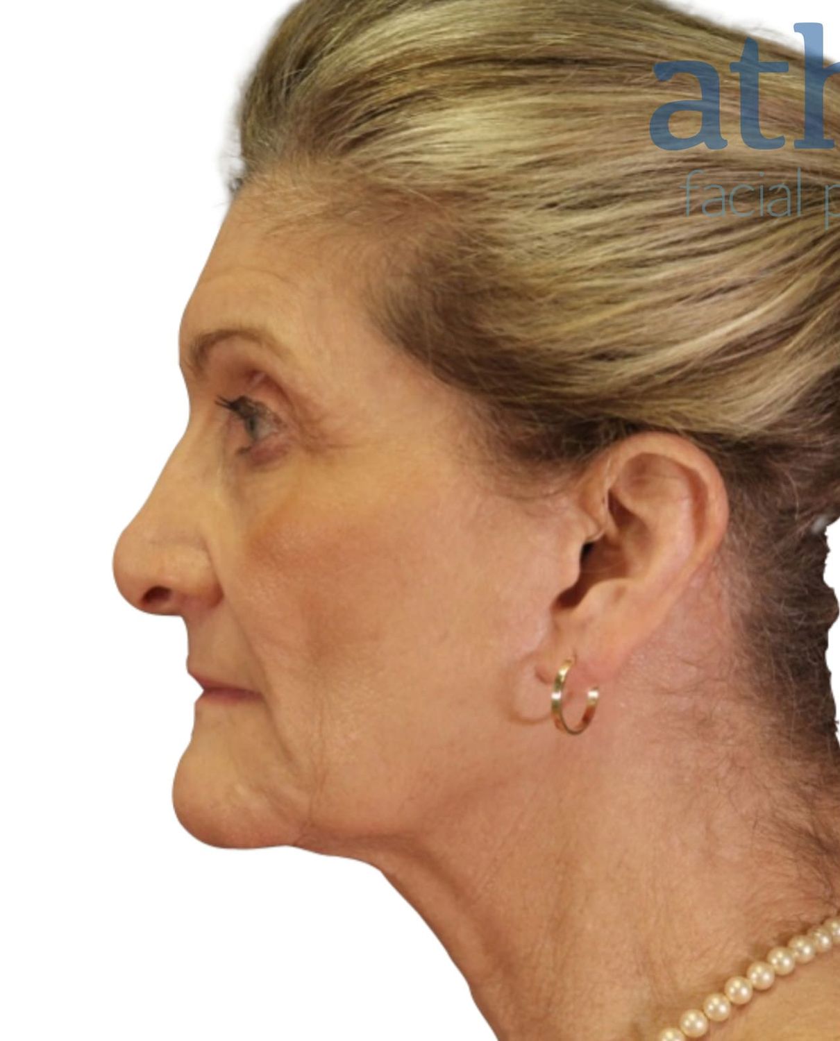 Neck Lift Before & After