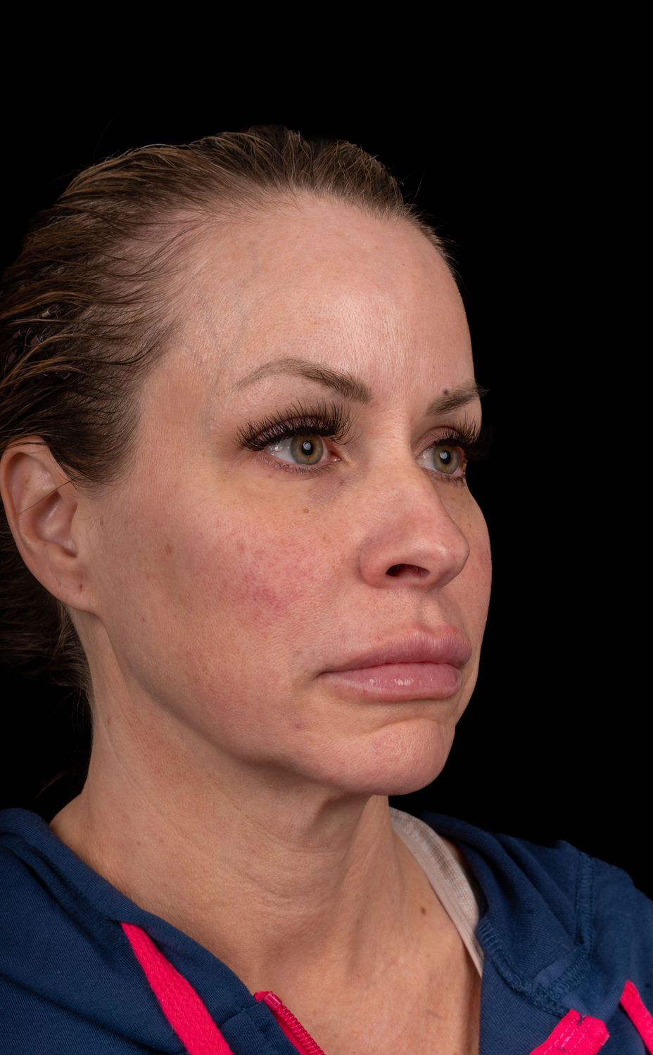 Neck Lift Before & After