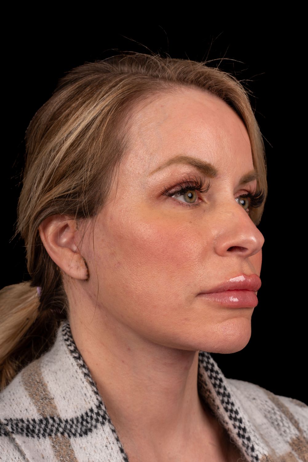 Neck Lift Before & After