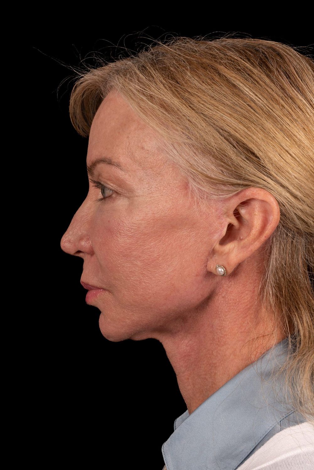 Neck Lift Before & After