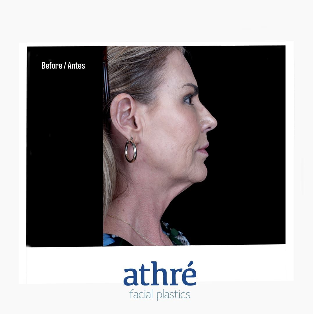 Neck Lift Before & After