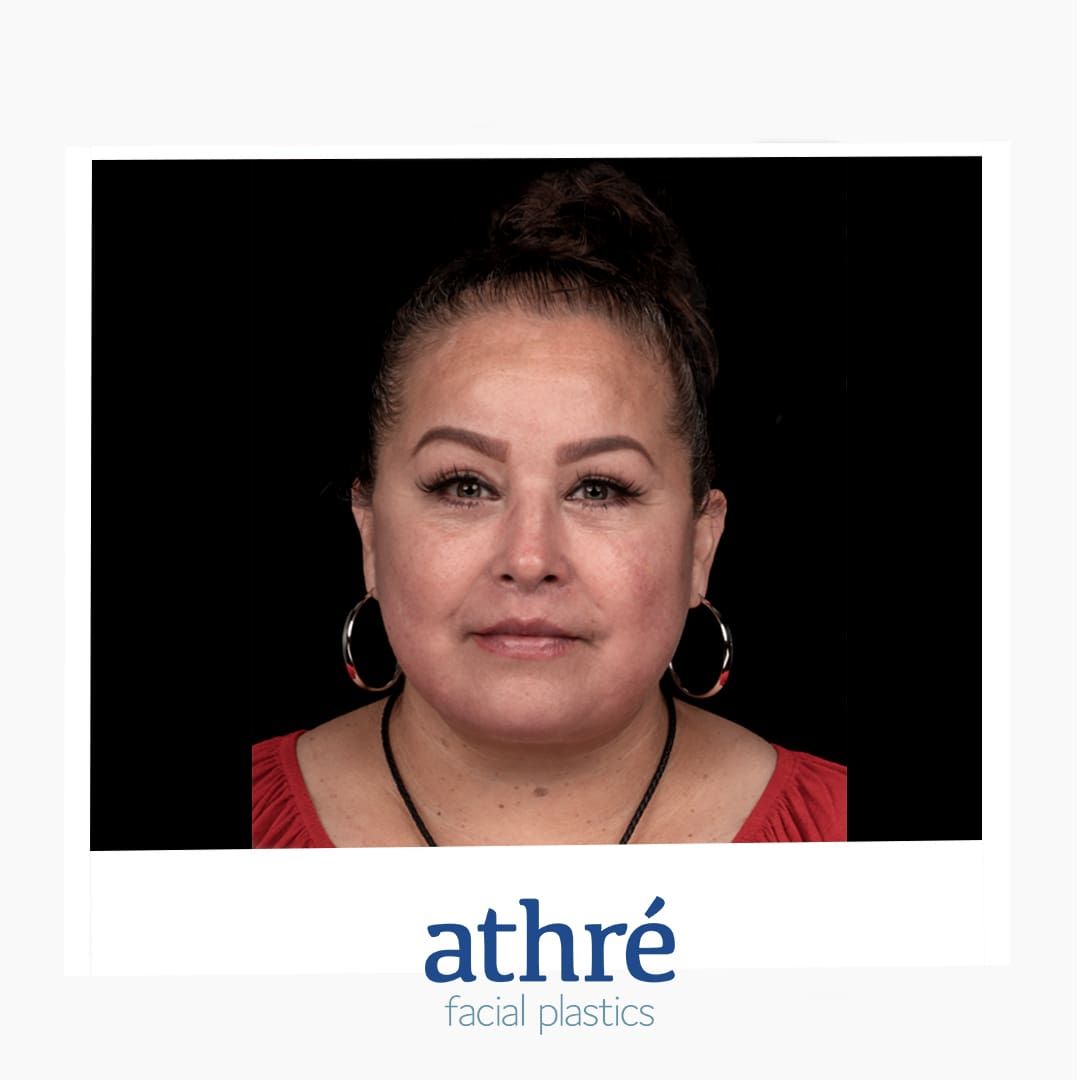 Neck Lift Before & After