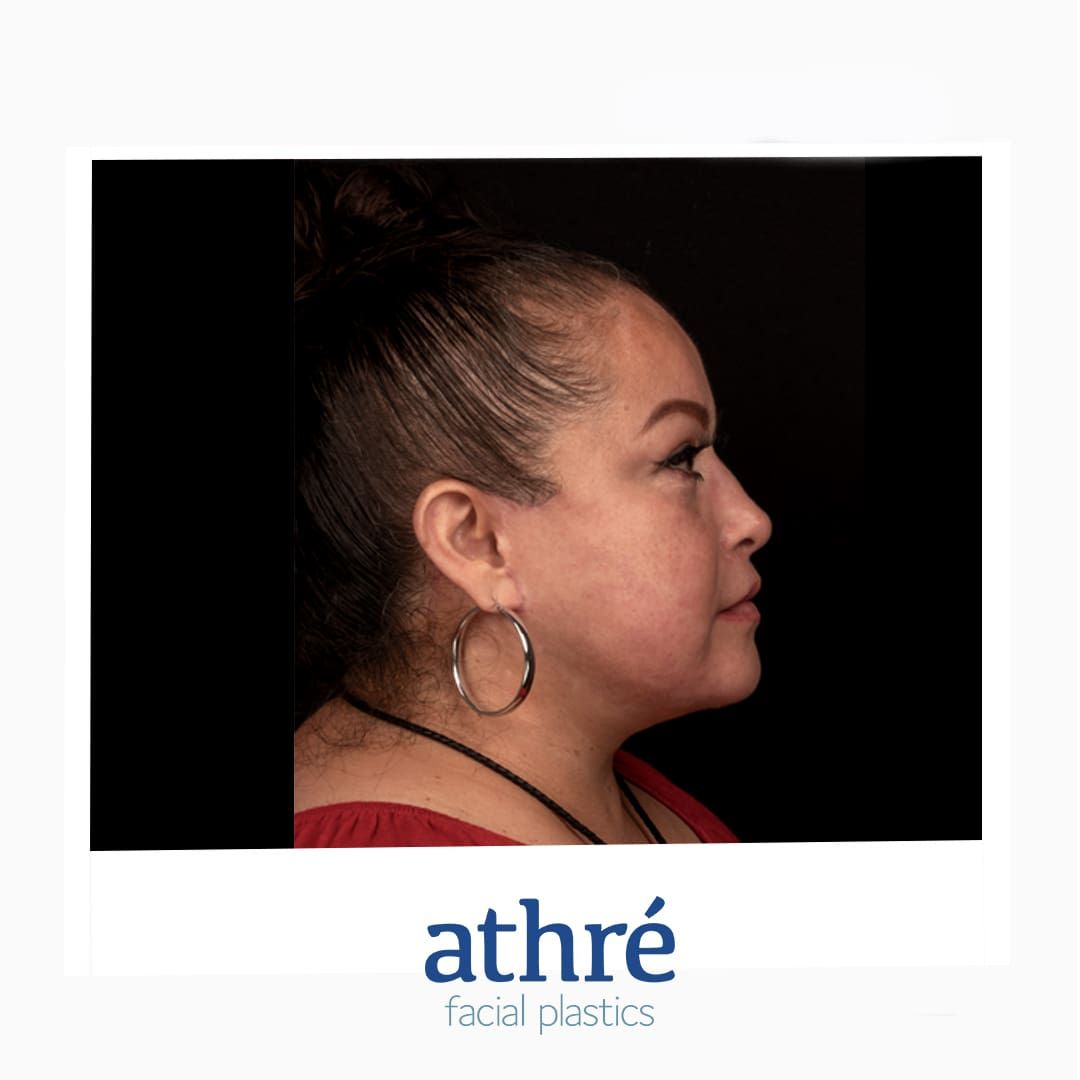 Neck Lift Before & After