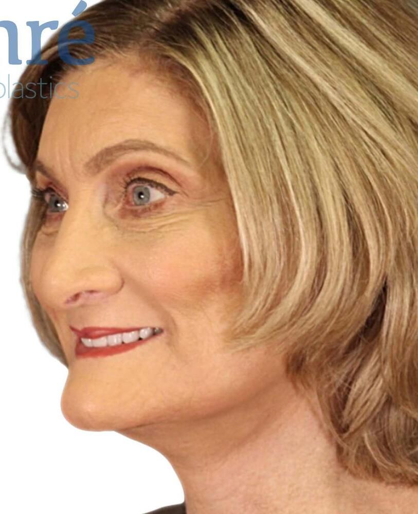 Under Eye Filler Before & After