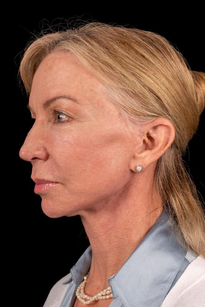 Under Eye Filler Before & After