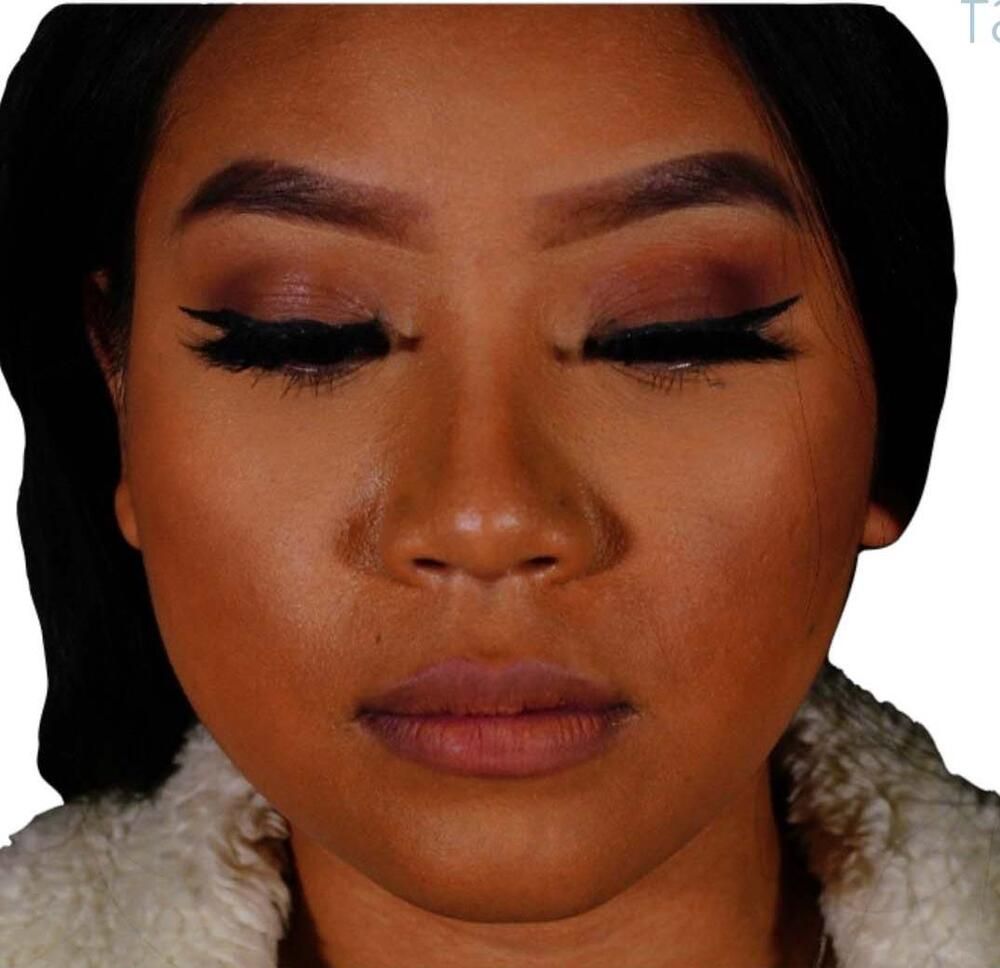 Restylane Before & After