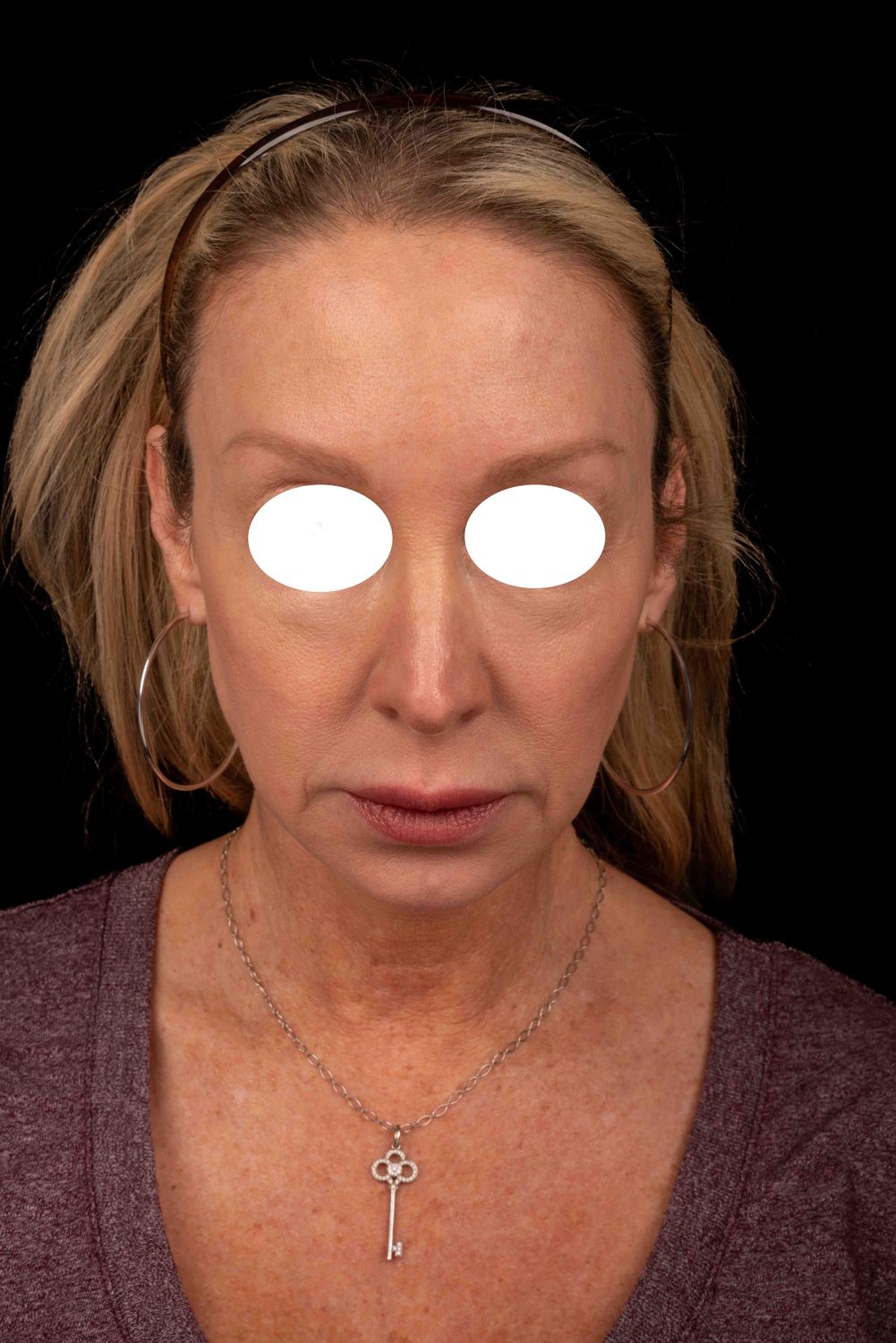 Facelift Before & After