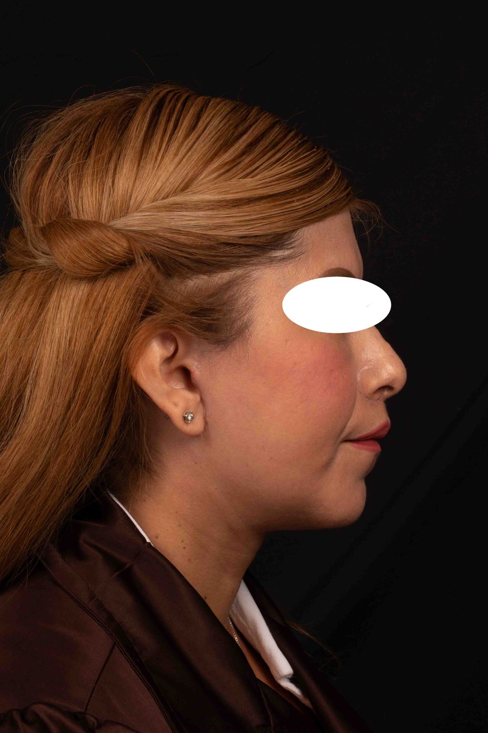 Facelift Before & After