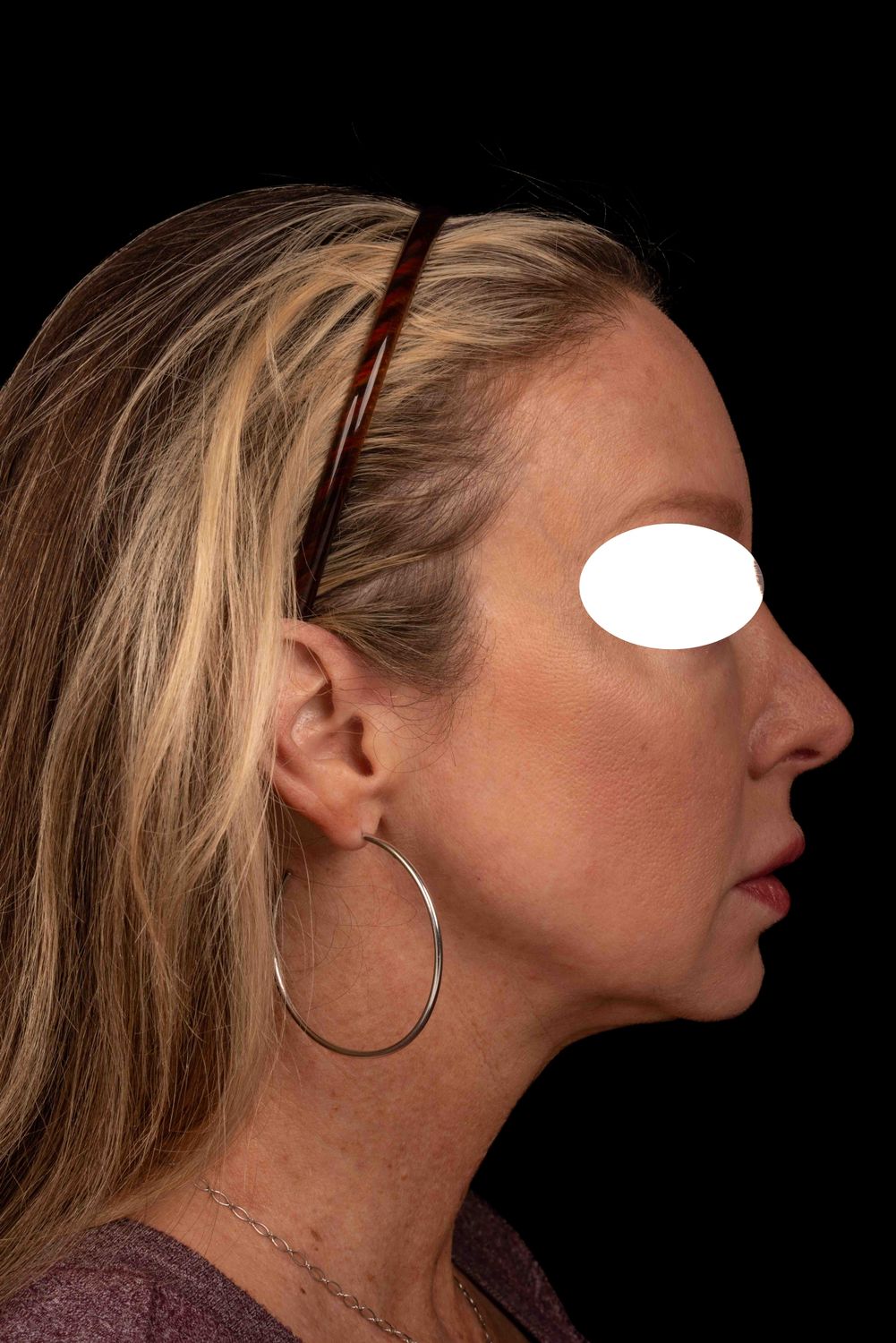 Facelift Before & After