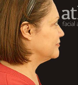 Facelift Before & After