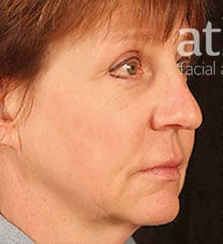 Facelift Before & After