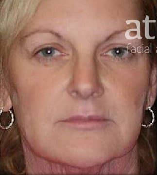 Facelift Before & After