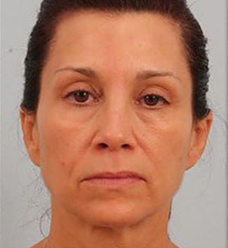 Facelift Before & After