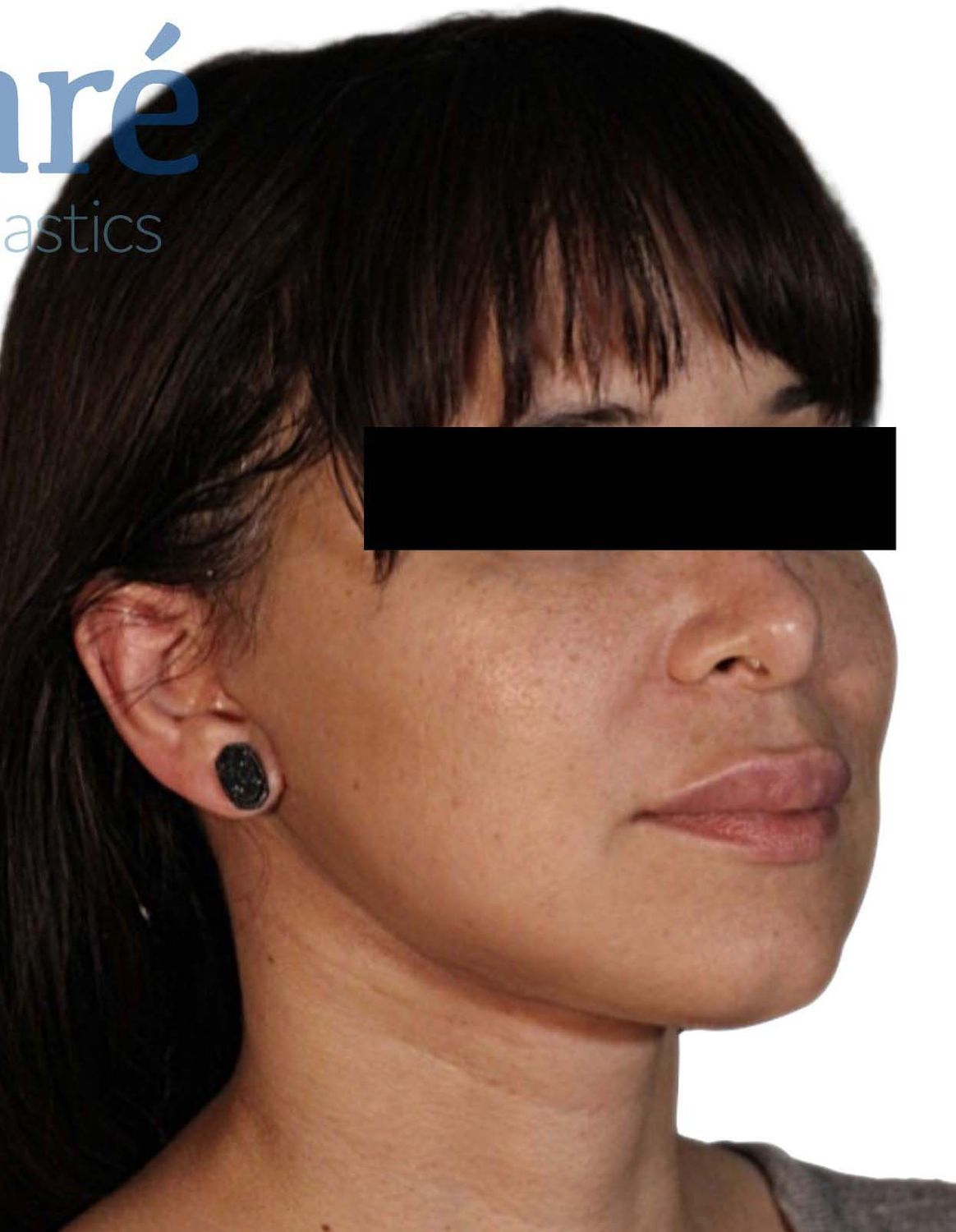 Facelift Before & After